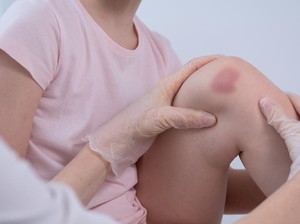 9 Penyebab Memar Tanpa Sebab dan Cara Mengatasinya yang Bisa Dilakukan di Rumah