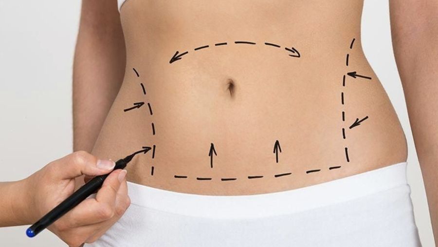 ilustrasi liposuction alias sedot lemak. (Dok: Freepik)