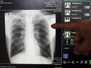 5 Penyakit yang Ada Sejak Zaman Kuno, Ada Masih Mewabah di Indonesia