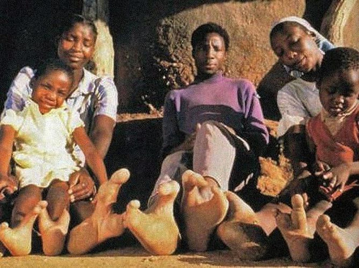 Kaki Lobster Suku Vadoma: Mutasi Genetik Langka Karena Pernikahan Inses