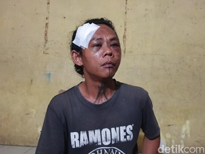 Jukir di Medan Dianiaya Gerombolan Pria Cepak, Kepalanya Dijahit-Matanya Lebam