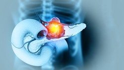 Dikira Sakit Punggung Biasa, Pria Ini Ternyata Idap Kanker Pankreas