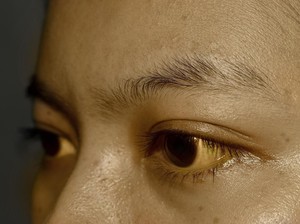 Asal Konsumsi Obat Herbal, Tubuh Wanita Ini Menguning Seperti Karakter Simpson
