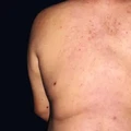 Tanda pada kulit jika terkena diabetes. (Dok. https://www.aad.org/)