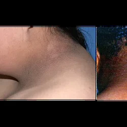 10 Tanda Diabetes yang Muncul di Kulit, Termasuk Ketiak Hitam