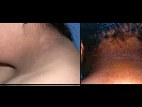 10 Tanda Diabetes yang Muncul di Kulit, Termasuk Ketiak Hitam