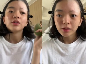 Heboh Pengakuan Wanita Jakbar, Efek Bleaching Rambut Betulan Picu Vitiligo?