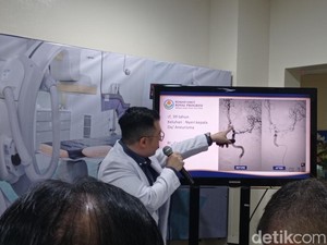 Dokter Spesialis Saraf: 90% Stroke Bisa Dicegah