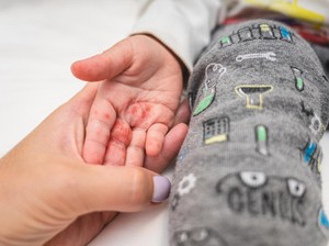 Tembus 5 Ribu Kasus di RI, Waspadai Penularan Flu Singapura