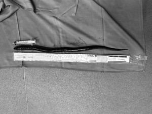 Merinding, Dokter Bedah di Vietnam Temukan Belut Hidup 30 Cm di Perut Pasien