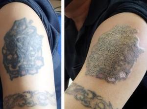 Penampakan Before-After Gambar di Lengan Fauzi Peserta Hapus Tato Gratis