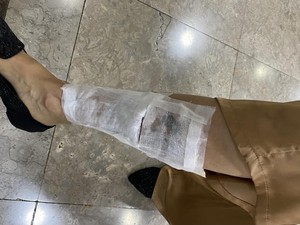Cerita Nita Hapus Tato yang Tutupi Luka: Celekit-celekit Sakit