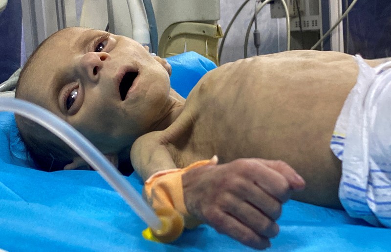 Balita Palestina Leila Jeneid, yang menderita kekurangan gizi parah, menerima perawatan di Rumah Sakit Kamal Adwan, di tengah konflik yang sedang berlangsung antara Israel dan Hamas di Gaza di mana kekurangan makanan dan nutrisi penting telah menjadi perjuangan kolektif di daerah kantong tersebut, di Jalur Gaza utara, 26 Maret 2024.REUTERS/Osama Abu Rabee