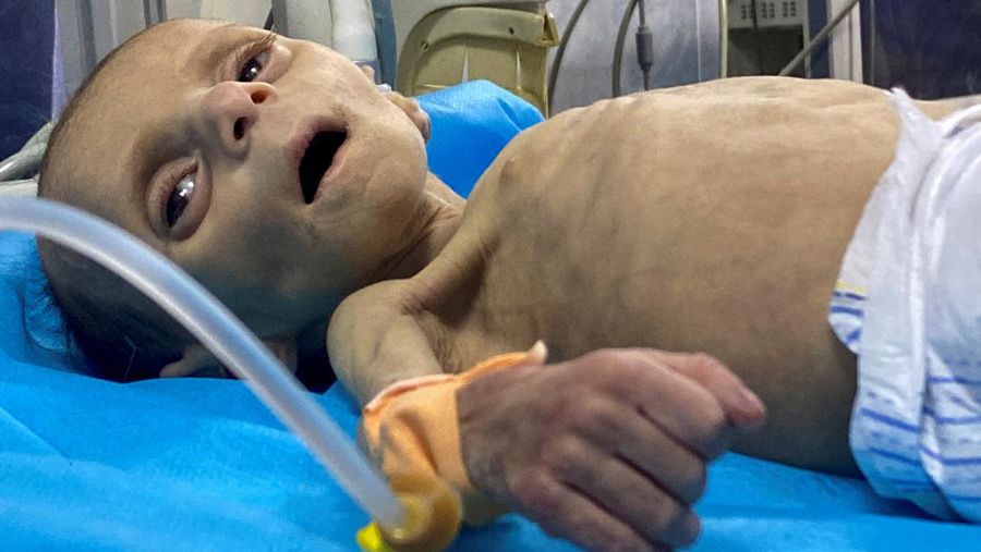 Balita Palestina Leila Jeneid, yang menderita kekurangan gizi parah, menerima perawatan di Rumah Sakit Kamal Adwan, di tengah konflik yang sedang berlangsung antara Israel dan Hamas di Gaza di mana kekurangan makanan dan nutrisi penting telah menjadi perjuangan kolektif di daerah kantong tersebut, di Jalur Gaza utara, 26 Maret 2024.REUTERS/Osama Abu Rabee
