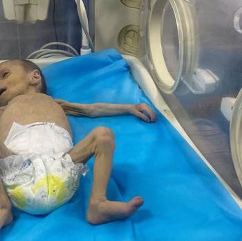 Potret Pedihnya Balita Palestina Berjuang Melawan Malnutrisi di Gaza