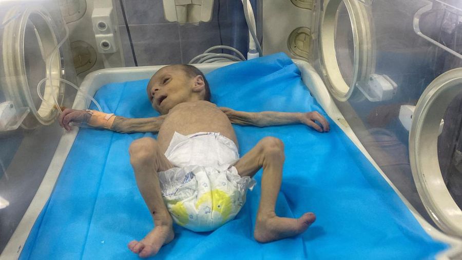 Balita Palestina Leila Jeneid, yang menderita kekurangan gizi parah, menerima perawatan di Rumah Sakit Kamal Adwan, di tengah konflik yang sedang berlangsung antara Israel dan Hamas di Gaza di mana kekurangan makanan dan nutrisi penting telah menjadi perjuangan kolektif di daerah kantong tersebut, di Jalur Gaza utara, 26 Maret 2024.REUTERS/Osama Abu Rabee