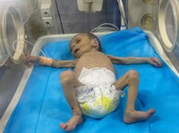 Potret Pedihnya Balita Palestina Berjuang Melawan Malnutrisi di Gaza