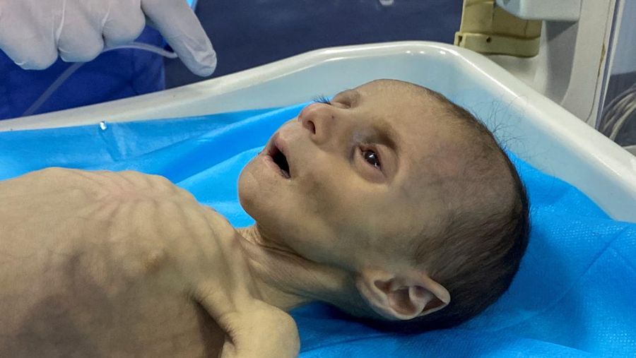 Balita Palestina Leila Jeneid, yang menderita kekurangan gizi parah, menerima perawatan di Rumah Sakit Kamal Adwan, di tengah konflik yang sedang berlangsung antara Israel dan Hamas di Gaza di mana kekurangan makanan dan nutrisi penting telah menjadi perjuangan kolektif di daerah kantong tersebut, di Jalur Gaza utara, 26 Maret 2024.REUTERS/Osama Abu Rabee
