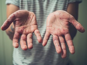 Kenali Perbedaan Lesi Akibat Flu Singapura dan Sariawan Biasa
