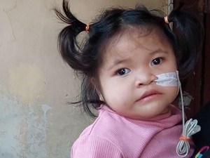 Kisah Pilu Reina Derita Kelainan Langka, Hilang Penglihatan hingga Memori