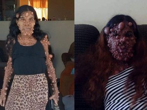Kondisi Terkini Wanita Idap Ribuan Tumor di Sekujur Tubuh usai Jalani Operasi