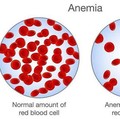 Kasusnya Langka Ditemukan, Ini Gejala-Pencegahan Anemia Aplastik