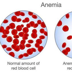 Kasusnya Langka Ditemukan, Ini Gejala-Pencegahan Anemia Aplastik