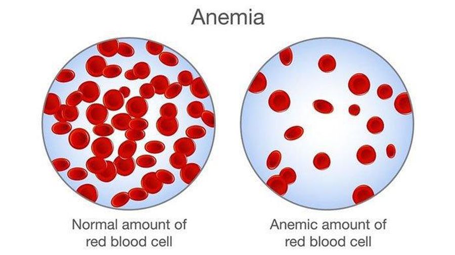 Ilustrasi sel darah merah normal dan kondisi anemia atau kekurangan sel darah merah. (Freepik)