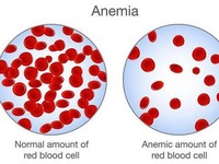 Kasusnya Langka Ditemukan, Ini Gejala-Pencegahan Anemia Aplastik