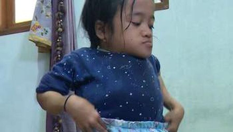 Rahma (12) seorang anak yang telah menjadi pejuang sejak lahir. Perempuan asal Kampung Cipadali, (Dok. berbuatbaik.id)
