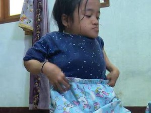 Kisah Rahma, Anak Guru Honorer Penderita Penyakit Tulang Langka