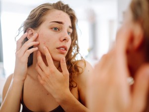 Apakah Bopeng Bisa Hilang dengan Skincare?
