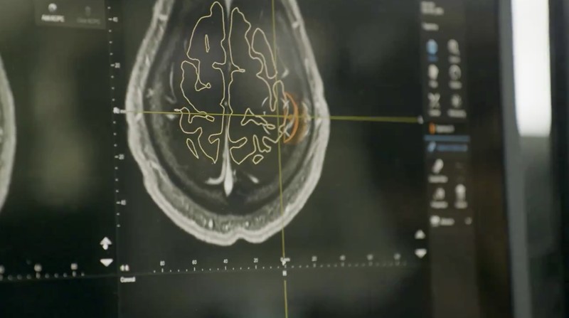 Noland Arbaugh, pasien pertama Neuralink. Noland Arbaugh, pasien pertama Neuralink. (X @neuralink)