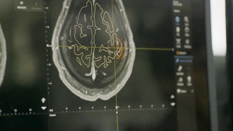Noland Arbaugh, pasien pertama Neuralink. (X @neuralink)