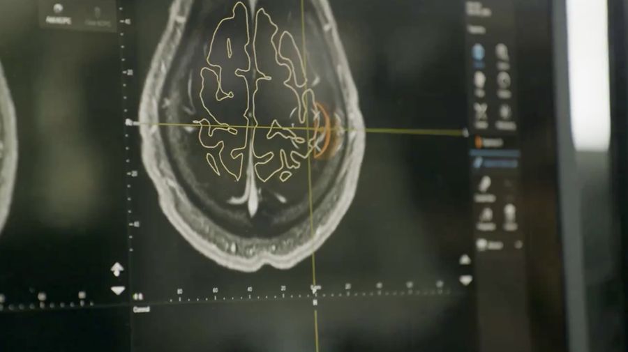 Neuralink buka-bukaan masalah pada proyek implan chip otak ke manusia. Startup milik Elon Musk tersebut mengaku ada kabel kecil yang salah posisi di dalam otak pasien pertamanya. (X @Neuralink)