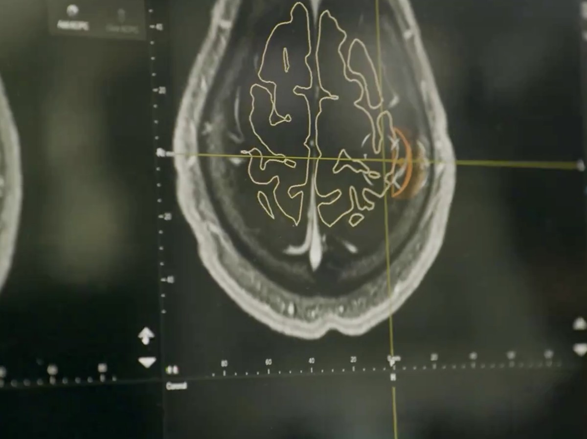 Neuralink Mulai Produksi Massal Chip Otak untuk Bantu Penyandang Lumpuh