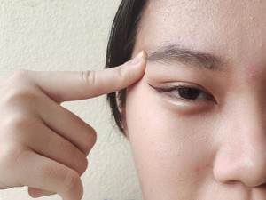 Kenapa Jerawat di Alis Sakit? Ini Penyebab dan Cara Mengobatinya