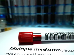 Sering Disangka Saraf Kejepit, Waspadai Gejala Kanker Multiple Myeloma
