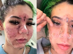Viral Tiktoker Nekat Pakai Skincare Kedaluwarsa, Wajahnya Jadi Begini