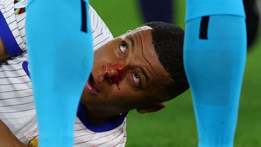 Kylian Mbappe dari Prancis mendapat perawatan setelah mengalami cedera saat laga Grup D antara Austria dan Prancis pada turnamen sepak bola Euro 2024 di Duesseldorf, Jerman, Senin, 17 Juni 2024. (AP Photo/Alessandra Tarantino)