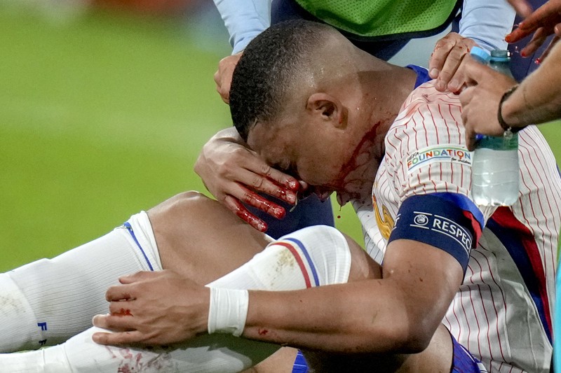 Kylian Mbappe dari Prancis mendapat perawatan setelah mengalami cedera saat laga Grup D antara Austria dan Prancis pada turnamen sepak bola Euro 2024 di Duesseldorf, Jerman, Senin, 17 Juni 2024. Kylian Mbappe dari Prancis mendapat perawatan setelah mengalami cedera saat laga Grup D antara Austria dan Prancis pada turnamen sepak bola Euro 2024 di Duesseldorf, Jerman, Senin, 17 Juni 2024. (AP Photo/Alessandra Tarantino)