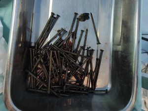 Kala 70 Paku Bersarang di Perut Pemuda Indramayu