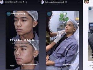 Betrand Peto Jalani Filler Dagu Biar Lebih Maskulin, Bagaimana Prosesnya?