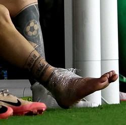 Penampakan Kaki Bengkak yang Bikin Messi Nangis di Copa America