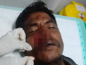 Pria di Sumba Barat Babak Belur Dihajar Kades Saat Hendak Lerai Pertengkaran