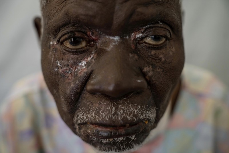 Seorang petugas kesehatan berjalan melewati pusat perawatan mpox di Munigi, Kongo timur, Senin, 19 Agustus 2024. Kongo akan menerima dosis vaksin pertama untuk mengatasi wabah mpox minggu depan dari Amerika Serikat, kata menteri kesehatan negara itu pada Senin, beberapa hari setelah Organisasi Kesehatan Dunia menyatakan wabah mpox di Afrika sebagai keadaan darurat global. (AP Photo/Moses Sawasawa)