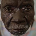 Mpox Masih Tahap Epidemi: Apa Artinya dan Cara Mencegahnya