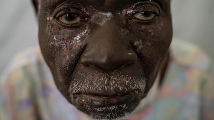 Christophe Chavilinga, 90, menderita mpox, menunggu perawatan di sebuah klinik di Munigi, Kongo timur, Jumat, 16 Agustus 2024. (AP Photo/Moses Sawasawa)