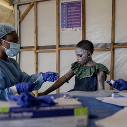 Wajib Tahu! Ini Daftar Gejala Mpox yang Mirip Covid-19