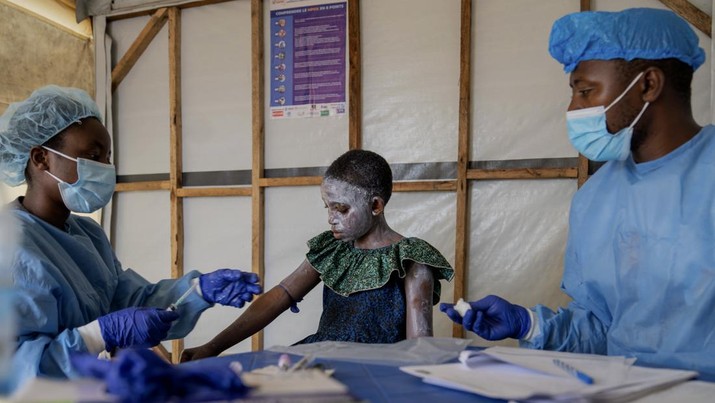 Petugas kesehatan merawat Lucie Habimana, 13 tahun, pasien mpox, di sebuah pusat perawatan di Munigi, Kongo timur, Jumat, 16 Agustus 2024. (AP Photo/Moses Sawasawa)